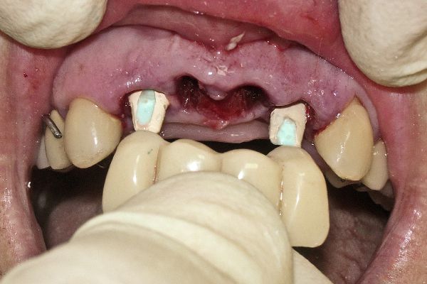 Фиксация временного протеза в полости рта
