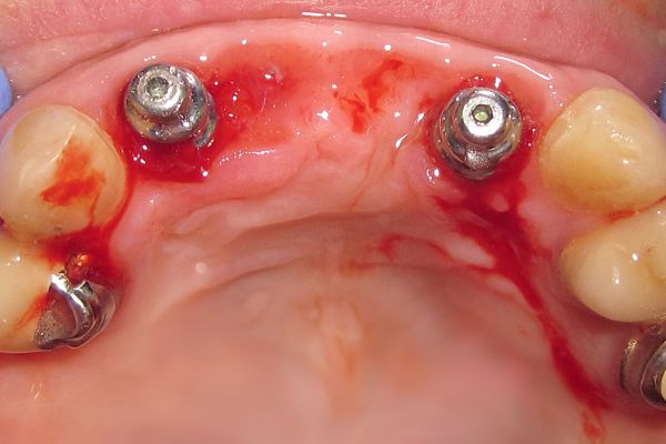 Постоянное протезирование фронтальной группы зубов