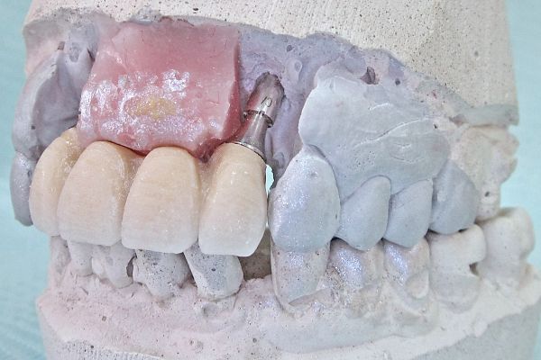 Постоянное протезирование фронтальной группы зубов