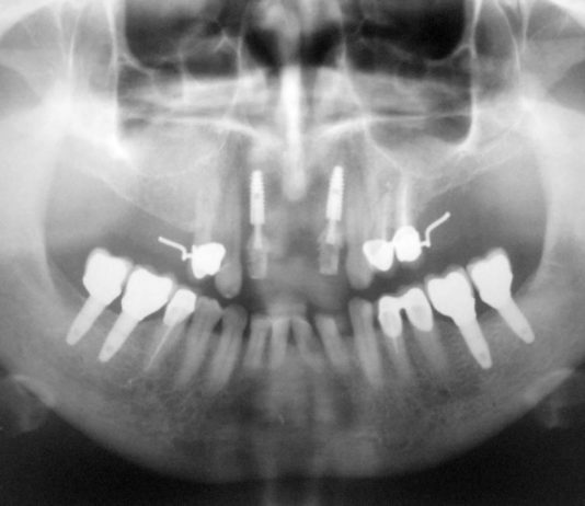 Сохранение контура десневого края в области зубов, подлежащих удалению, при отсроченной имплантации